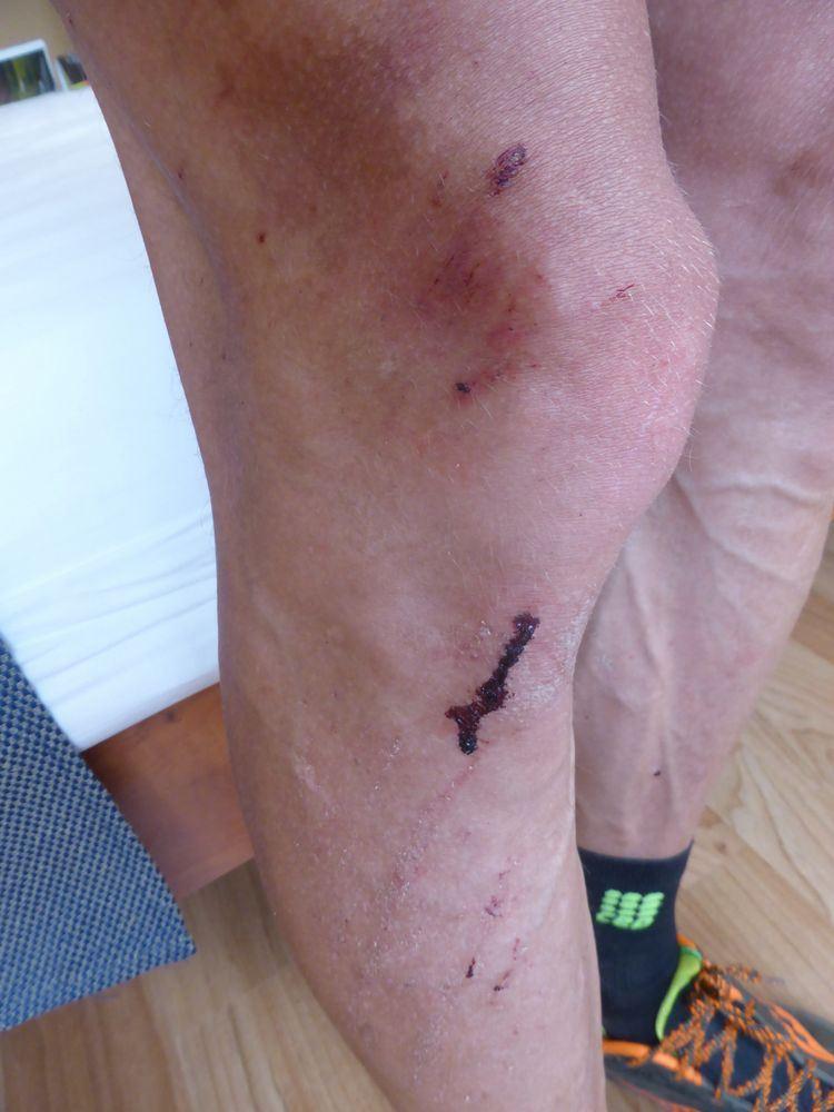 Leichte Blessuren :-)